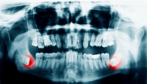 Everything You Should Know About Surgical Tooth Extraction