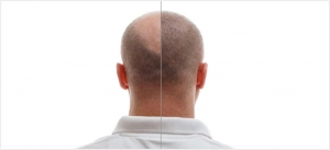 Why Do Most Men Need a Hair Transplant? Why Do Most Men Need a Hair Transplant?